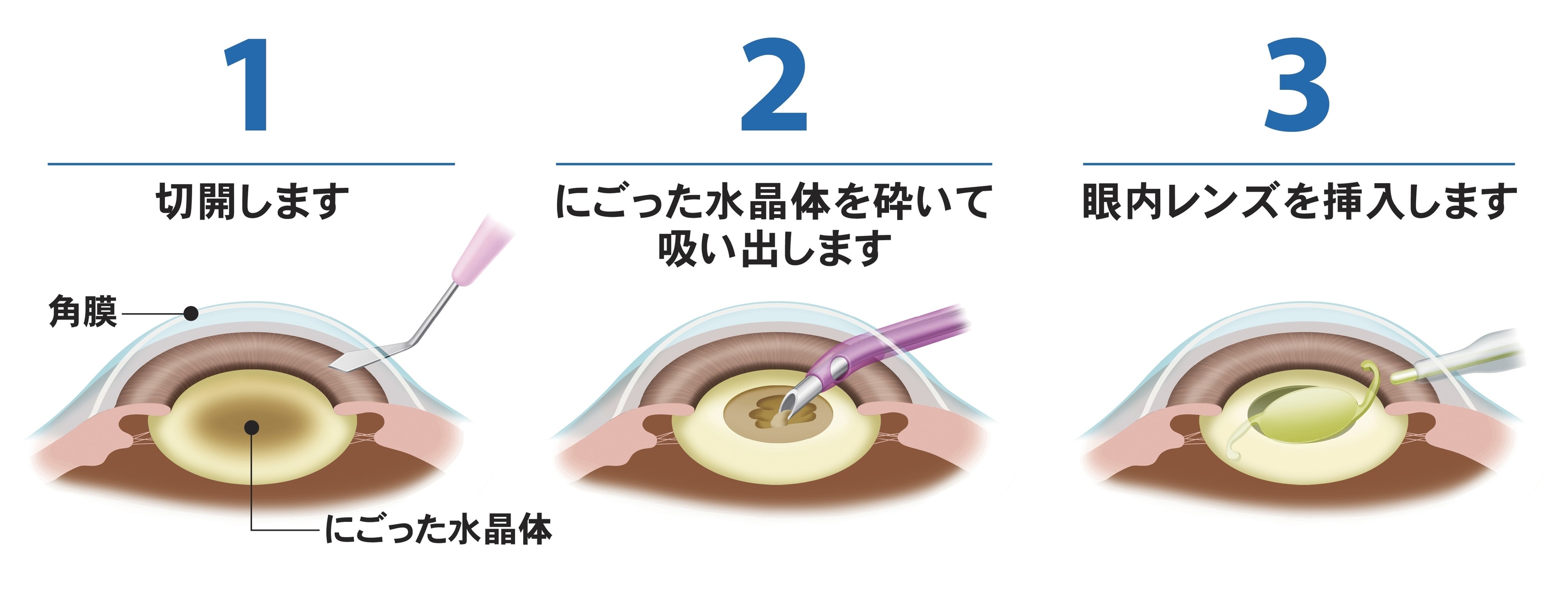 治療案内｜ にしこく眼科 日帰り手術・白内障・メガネ・仮性近視・眼精